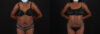 Liposuction case #6016 slider thumbnail