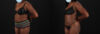 Liposuction case #6016 slider thumbnail
