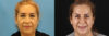 Botox® & Other Neuromodulators case #5051 slider thumbnail