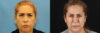 Botox® & Other Neuromodulators case #5051 slider thumbnail