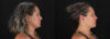 Botox® & Other Neuromodulators case #5056 slider thumbnail