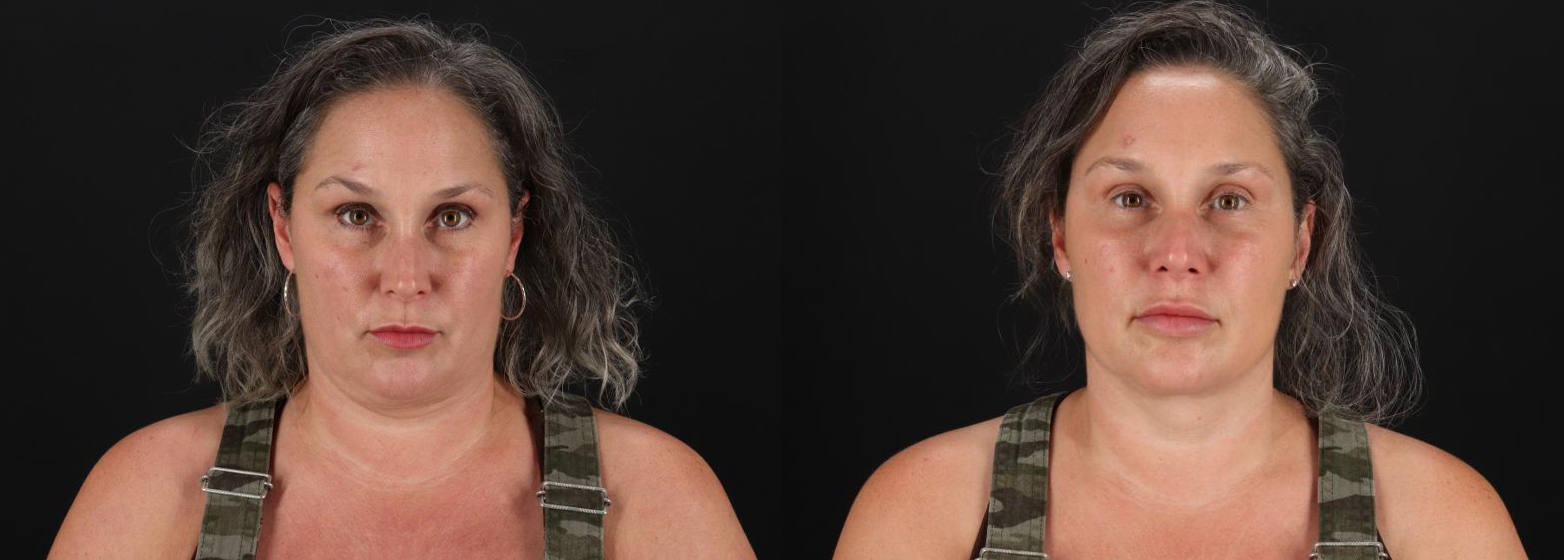 13402-13879-Botox-before-and-after-photo-by-Dr.-Erika-A.-Sato-in-Houston-TX