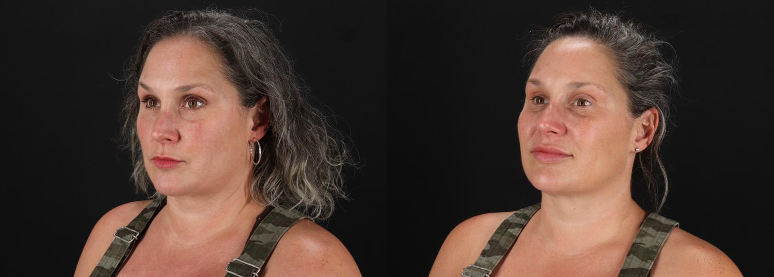 13402-55733-Botox-before-and-after-photo-by-Dr.-Erika-A.-Sato-in-Houston-TX