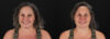 Botox® & Other Neuromodulators case #5056 slider thumbnail