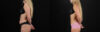Liposuction case #6018 slider thumbnail