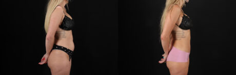 Liposuction case #6018
