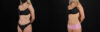 Liposuction case #6018 slider thumbnail