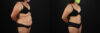 Tummy Tuck case #7354 slider thumbnail