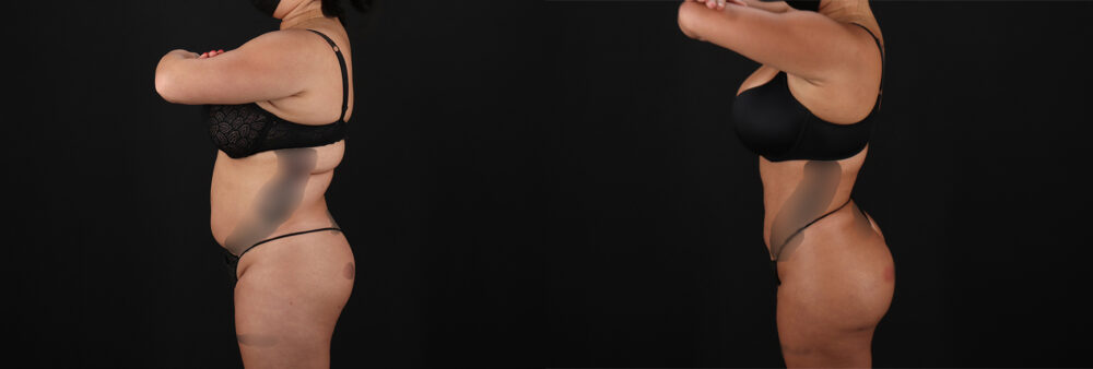 Brazilian Butt Lift case #5269