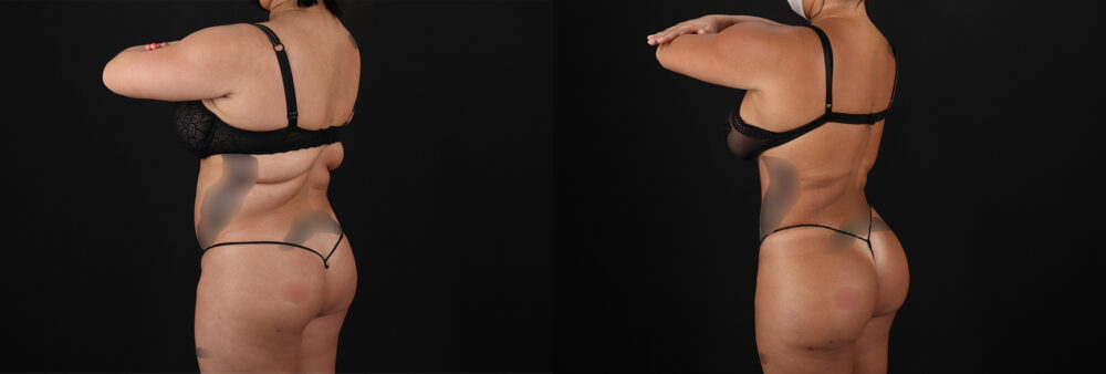 Brazilian Butt Lift case #5269