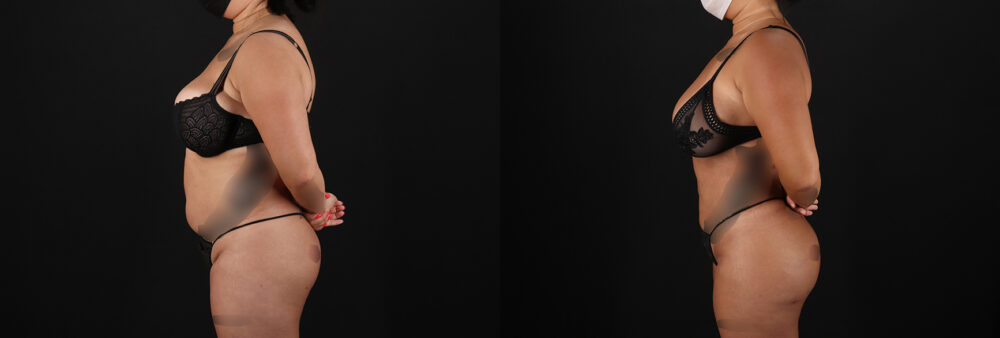 Brazilian Butt Lift case #5269