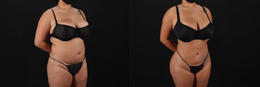 Brazilian Butt Lift case #5269