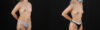 Liposuction case #6020 slider thumbnail