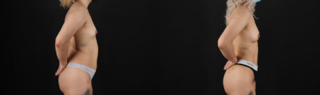 Liposuction case #6020