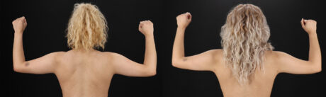 Liposuction case #6020