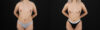 Liposuction case #6020 slider thumbnail