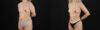 Liposuction case #6020 slider thumbnail