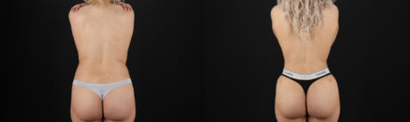 Liposuction case #6020