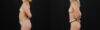 Liposuction case #6020 slider thumbnail