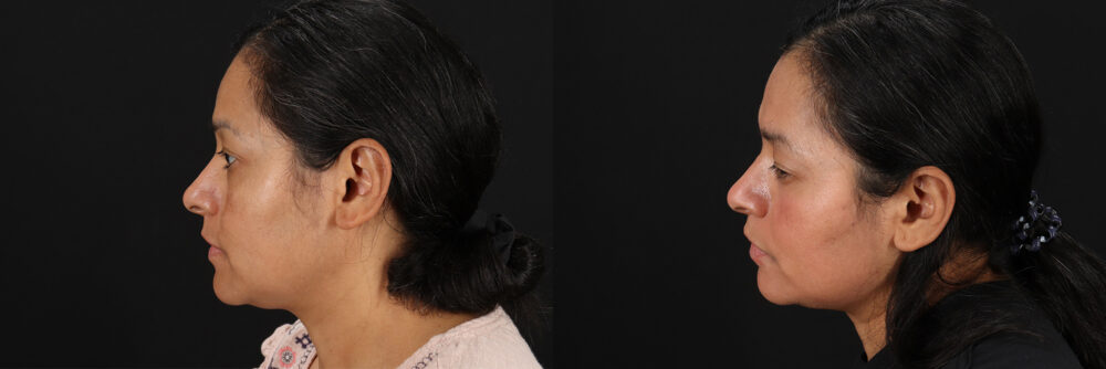 Cosmelan Chemical Peel case #5081