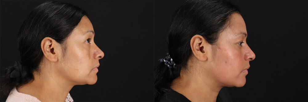 Cosmelan Chemical Peel case #5081