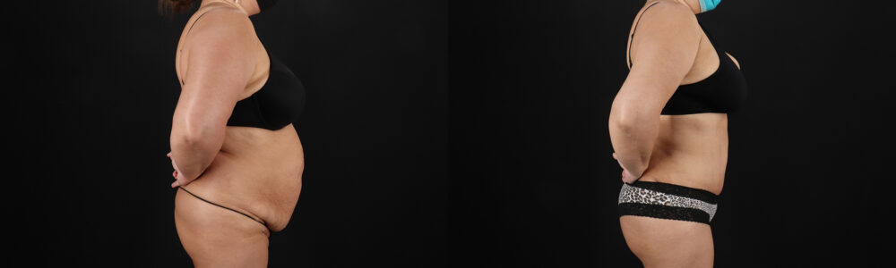 Brazilian Butt Lift case #5267