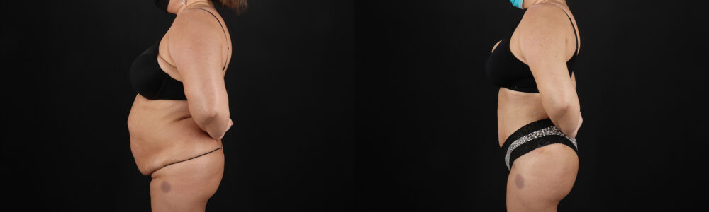 Brazilian Butt Lift case #5267