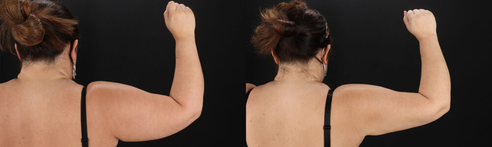 Brazilian Butt Lift case #5267