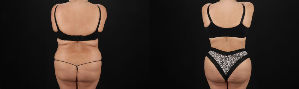 Brazilian Butt Lift case #5267