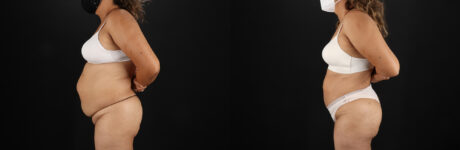 Liposuction case #6111