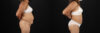 Liposuction case #6111 slider thumbnail
