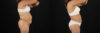 Liposuction case #6111 slider thumbnail