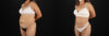 Liposuction case #6111 slider thumbnail