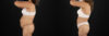 Liposuction case #6111 slider thumbnail