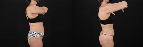 Liposuction case #6112