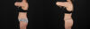 Liposuction case #6112 slider thumbnail