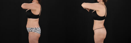 Liposuction case #6112