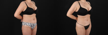 Liposuction case #6112