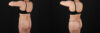 Liposuction case #6112 slider thumbnail