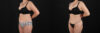 Liposuction case #6112 slider thumbnail