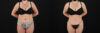 Liposuction case #6112 slider thumbnail