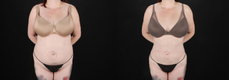 Liposuction case #6019