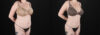 Liposuction case #6019 slider thumbnail