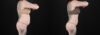 Liposuction case #6019 slider thumbnail