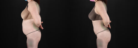 Liposuction case #6019