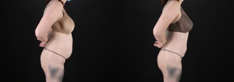 Liposuction case #6019