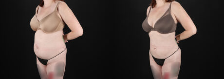 Liposuction case #6019