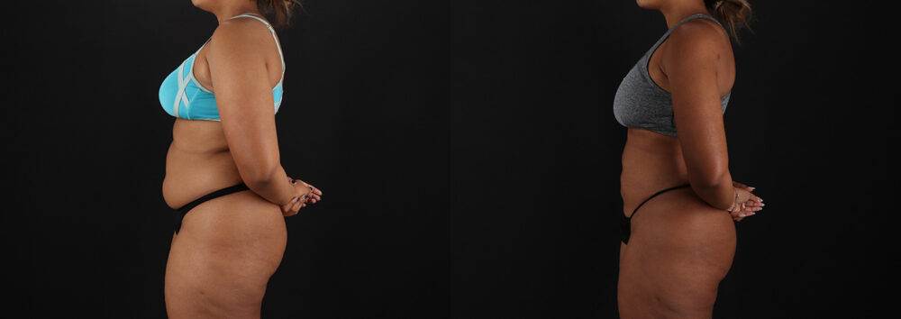 Brazilian Butt Lift case #5513