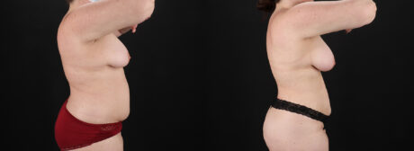 Liposuction case #6117