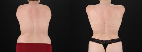 Liposuction case #6117